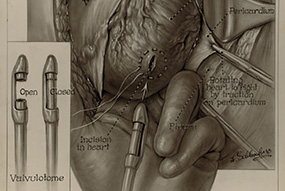 Pericardium Divided Anteriorly