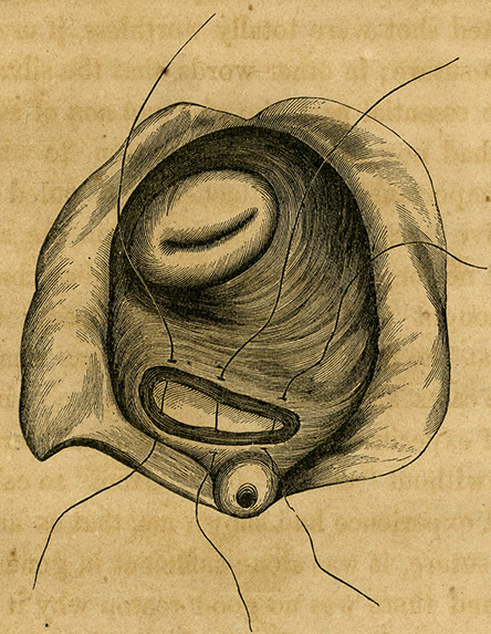Sims Speculum