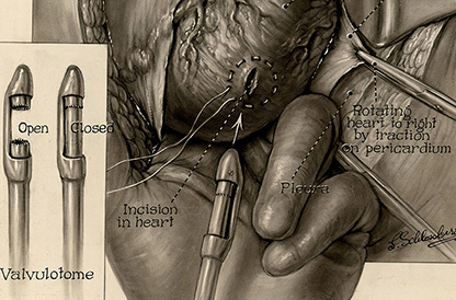  Illustration of cardiovascular procedure with captions. Inset illustration of open and closed valvulotome appears in the bottom, left corner of the parent illustration..